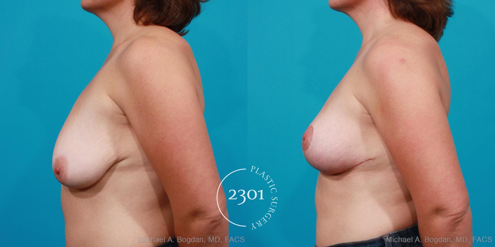 Before & After Breast Lift (Mastopexy) Case 167 View #2 View in Fort Worth, Plano, & Frisco, Texas
