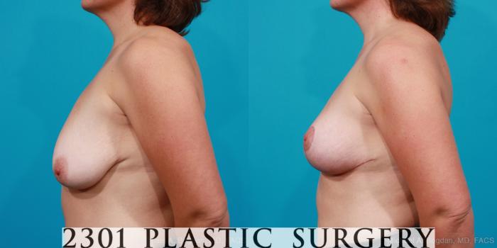 Before & After Breast Lift (Mastopexy) Case 167 View #2 View in Fort Worth, Plano, & Frisco, Texas