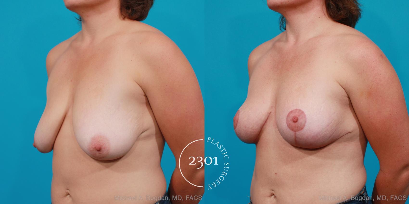 Before & After Breast Lift (Mastopexy) Case 167 View #3 View in Fort Worth, Plano, & Frisco, Texas