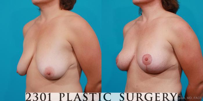 Before & After Breast Lift (Mastopexy) Case 167 View #3 View in Fort Worth, Plano, & Frisco, Texas