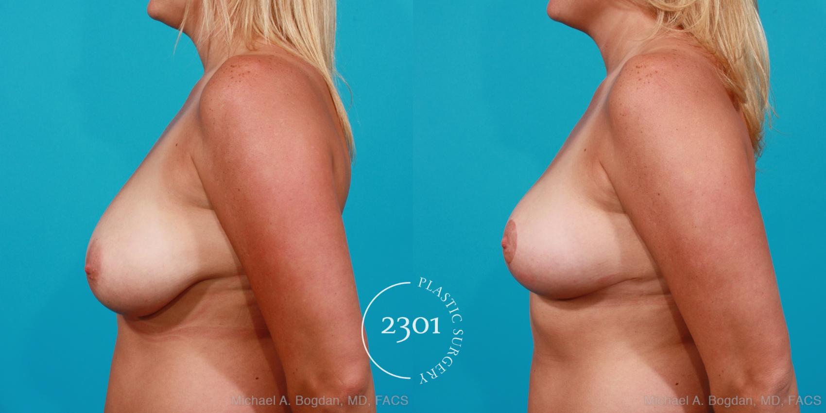 Before & After Breast Lift (Mastopexy) Case 203 View #2 View in Fort Worth, Plano, & Frisco, Texas