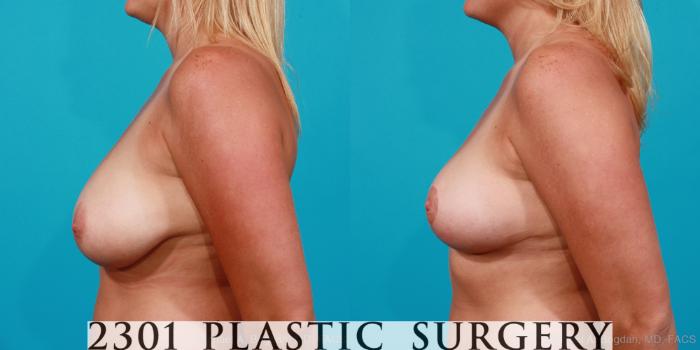 Before & After Breast Lift (Mastopexy) Case 203 View #2 View in Fort Worth, Plano, & Frisco, Texas
