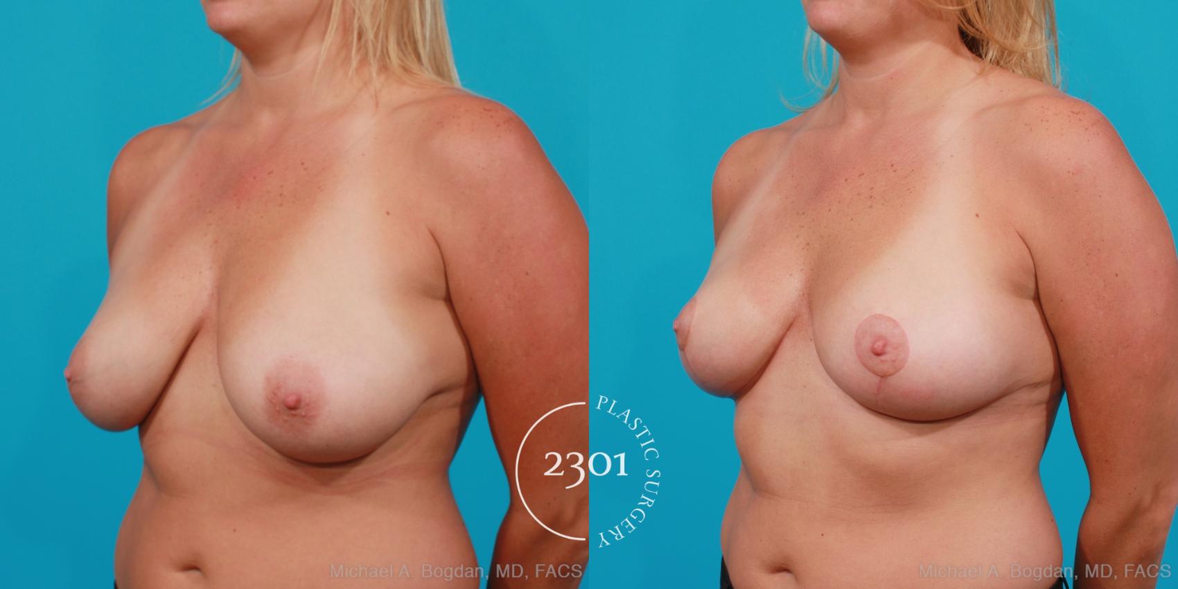 Before & After Breast Lift (Mastopexy) Case 203 View #3 View in Fort Worth, Plano, & Frisco, Texas