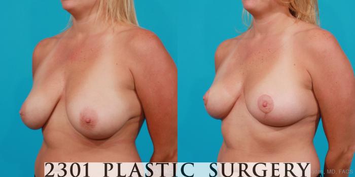Before & After Breast Lift (Mastopexy) Case 203 View #3 View in Fort Worth, Plano, & Frisco, Texas