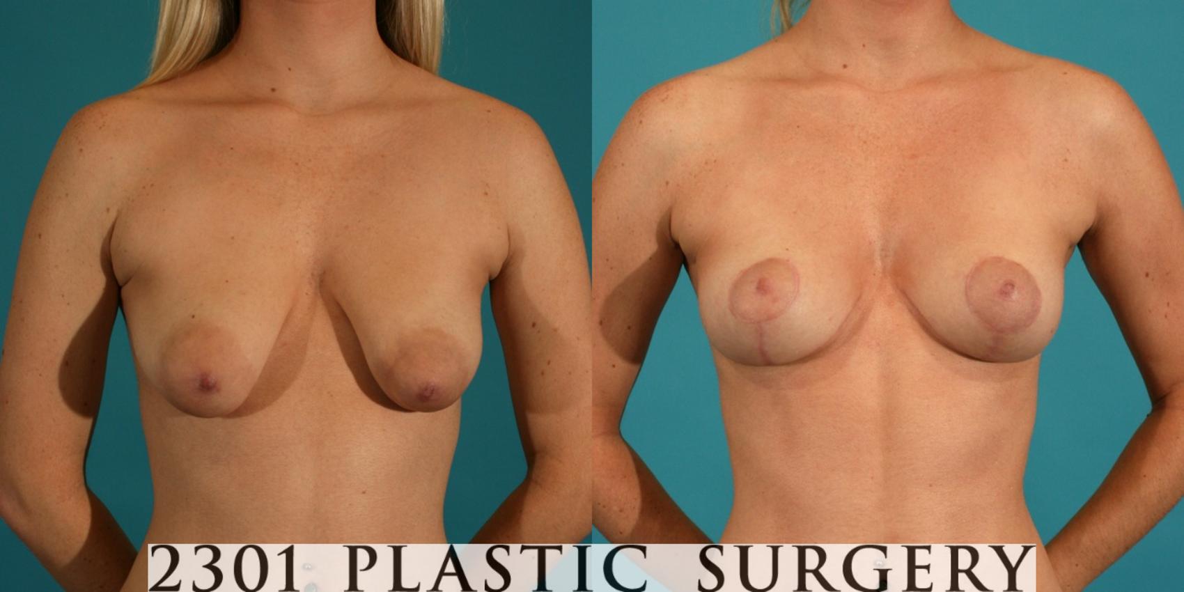Before & After Breast Lift (Mastopexy) Case 24 View #1 View in Fort Worth, Plano, & Frisco, Texas