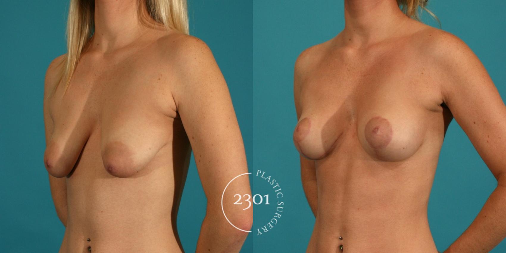 Before & After Breast Lift (Mastopexy) Case 24 View #3 View in Fort Worth, Plano, & Frisco, Texas