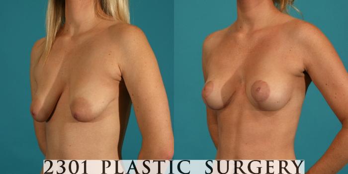 Before & After Breast Lift (Mastopexy) Case 24 View #3 View in Fort Worth, Plano, & Frisco, Texas