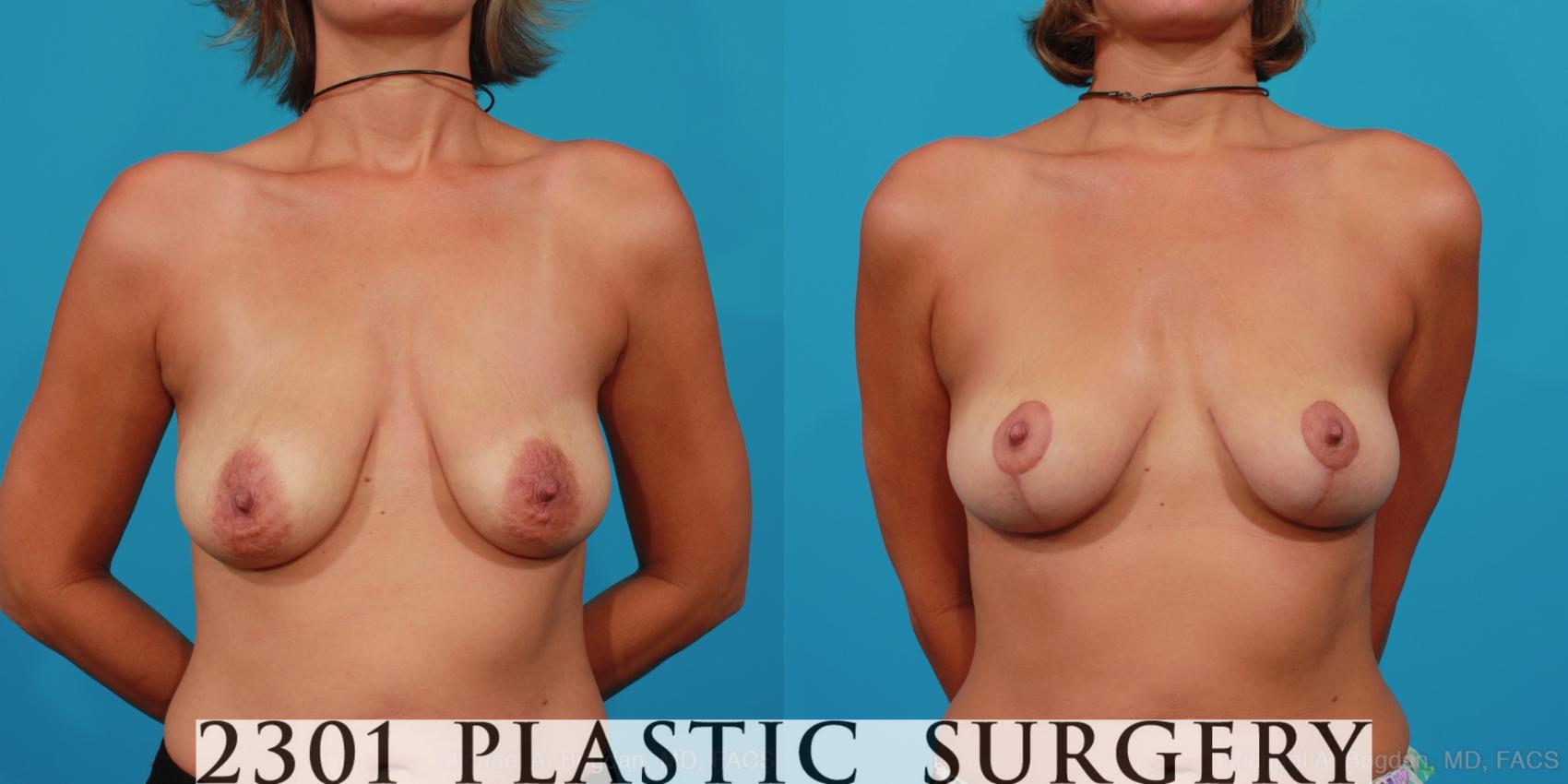 Before & After Breast Lift (Mastopexy) Case 248 View #1 View in Fort Worth, Plano, & Frisco, Texas