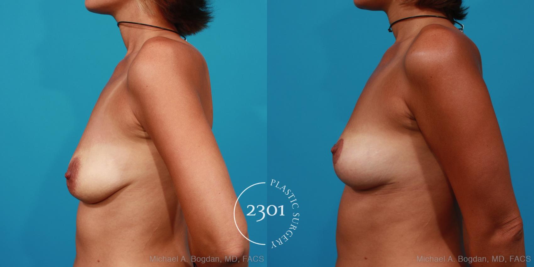 Before & After Breast Lift (Mastopexy) Case 248 View #2 View in Fort Worth, Plano, & Frisco, Texas