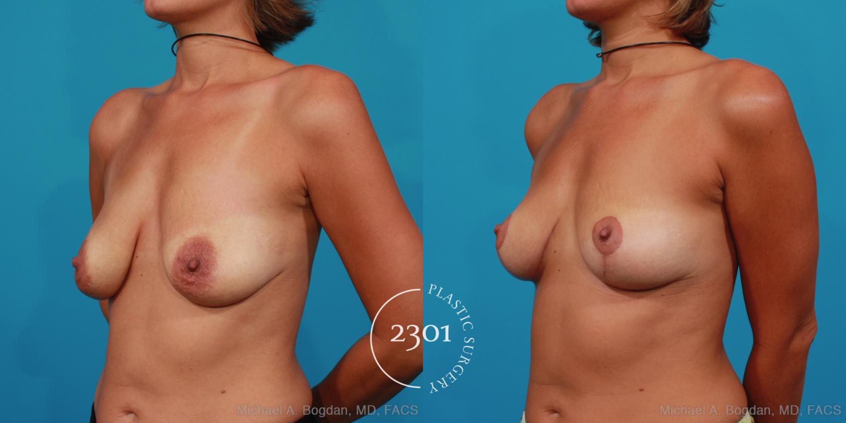 Before & After Breast Lift (Mastopexy) Case 248 View #3 View in Fort Worth, Plano, & Frisco, Texas
