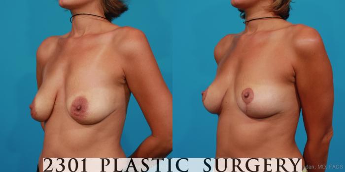 Before & After Breast Lift (Mastopexy) Case 248 View #3 View in Fort Worth, Plano, & Frisco, Texas