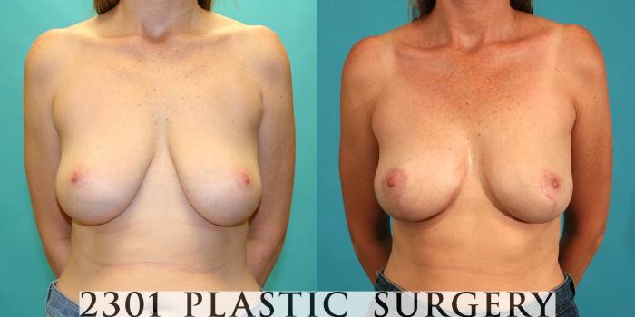 Before & After Breast Lift (Mastopexy) Case 25 View #1 View in Fort Worth, Plano, & Frisco, Texas