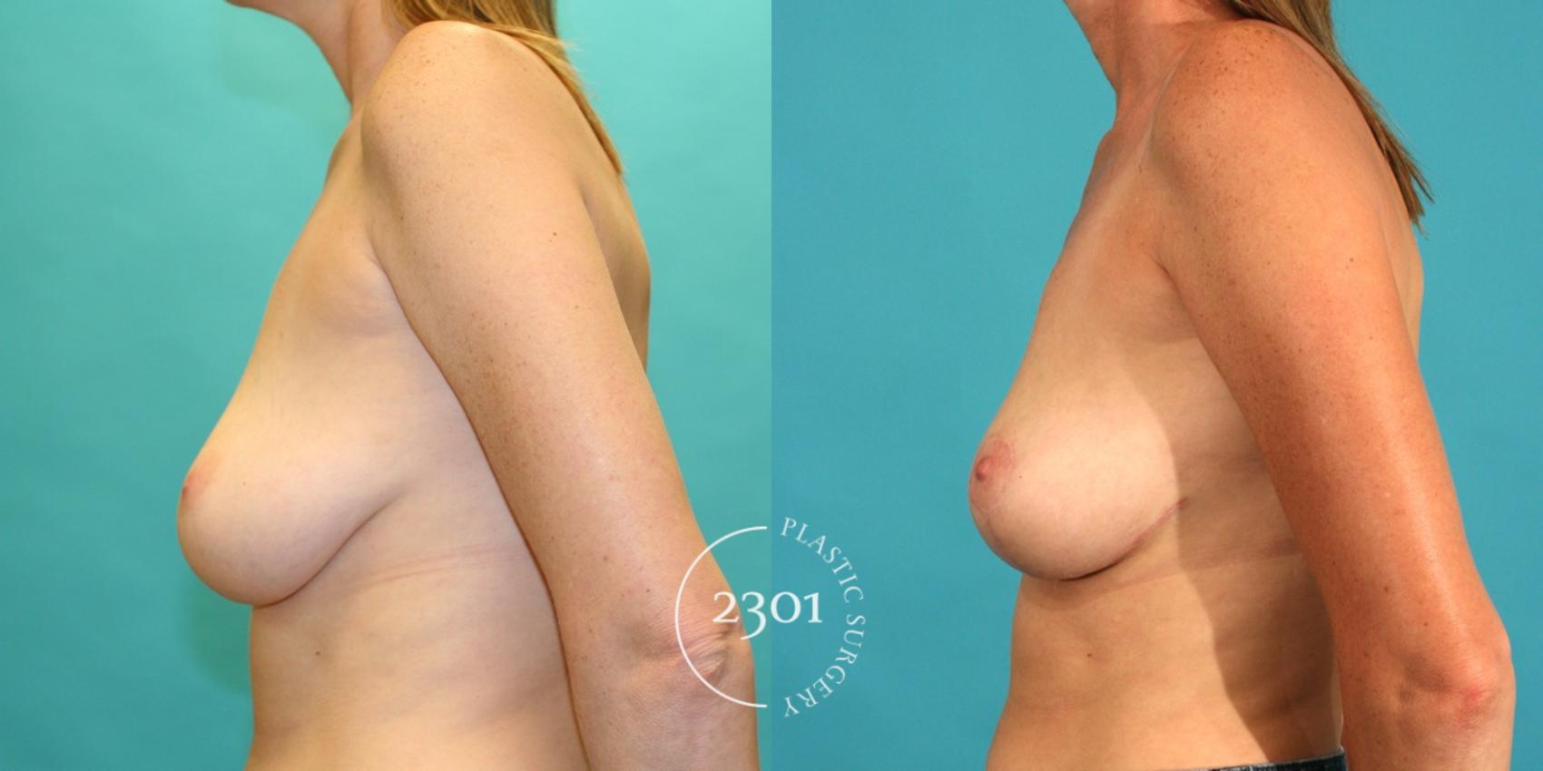 Before & After Breast Lift (Mastopexy) Case 25 View #2 View in Fort Worth, Plano, & Frisco, Texas