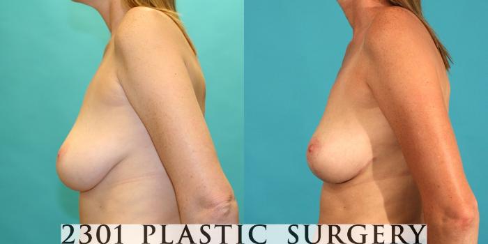 Before & After Breast Lift (Mastopexy) Case 25 View #2 View in Fort Worth, Plano, & Frisco, Texas