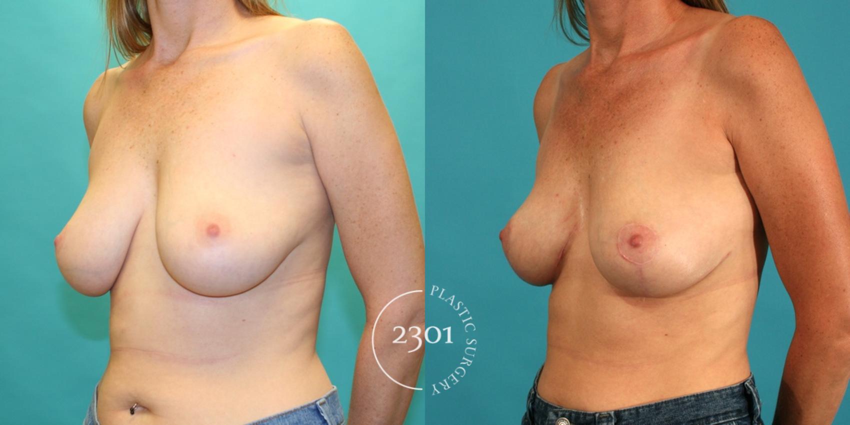 Before & After Breast Lift (Mastopexy) Case 25 View #3 View in Fort Worth, Plano, & Frisco, Texas
