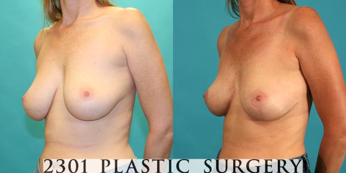 Before & After Breast Lift (Mastopexy) Case 25 View #3 View in Fort Worth, Plano, & Frisco, Texas