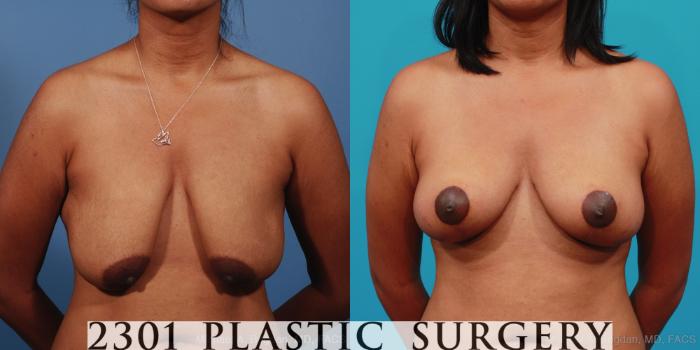 Before & After Breast Lift (Mastopexy) Case 253 View #1 View in Fort Worth, Plano, & Frisco, Texas