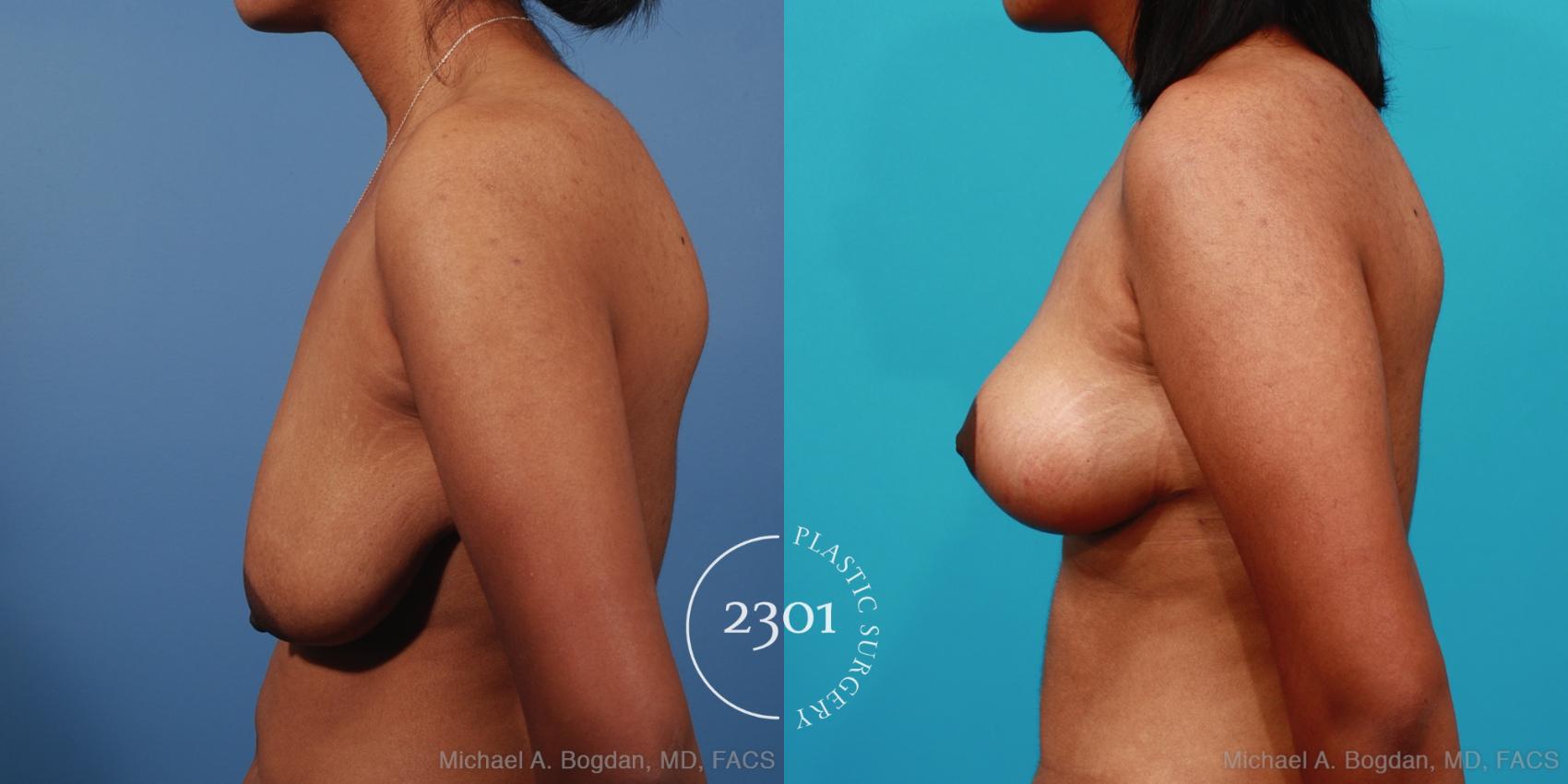 Before & After Breast Lift (Mastopexy) Case 253 View #2 View in Fort Worth, Plano, & Frisco, Texas