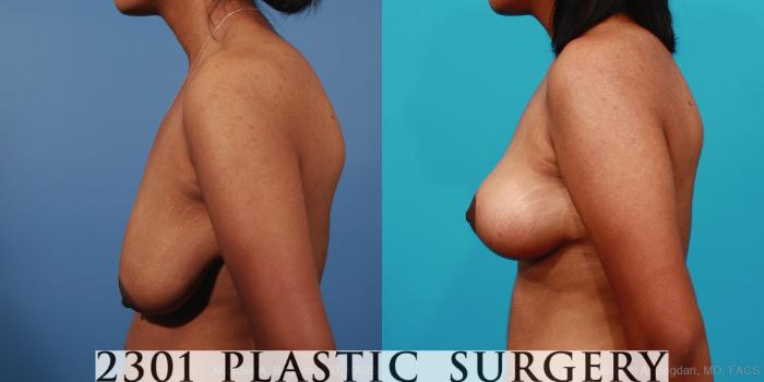 Before & After Breast Lift (Mastopexy) Case 253 View #2 View in Fort Worth, Plano, & Frisco, Texas