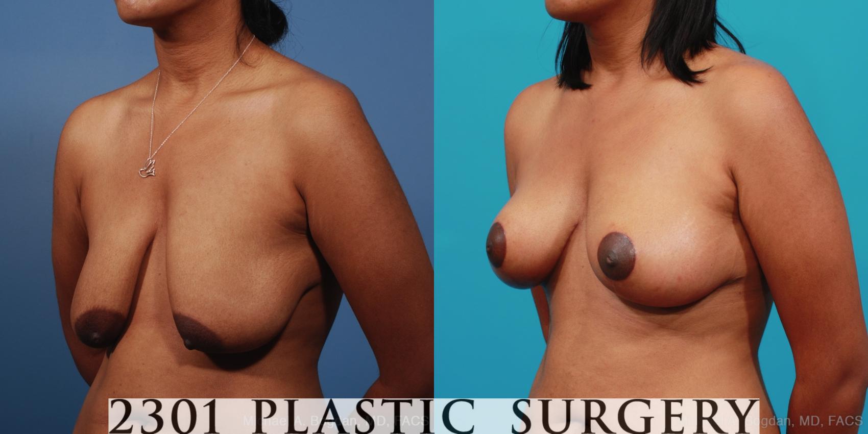 Before & After Breast Lift (Mastopexy) Case 253 View #3 View in Fort Worth & Frisco, Texas