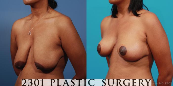 Before & After Breast Lift (Mastopexy) Case 253 View #3 View in Fort Worth, Plano, & Frisco, Texas