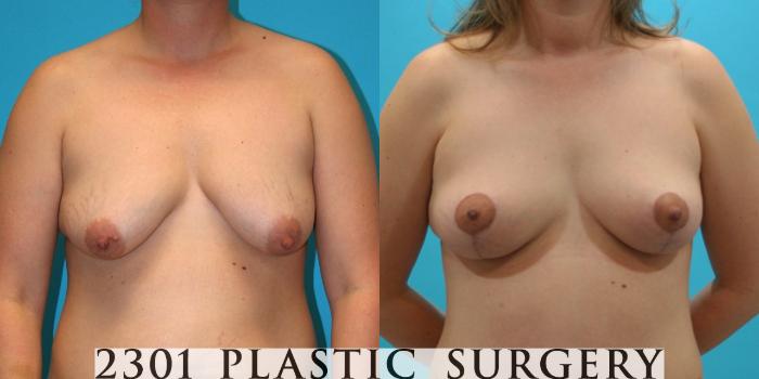 Before & After Breast Lift (Mastopexy) Case 26 View #1 View in Fort Worth, Plano, & Frisco, Texas