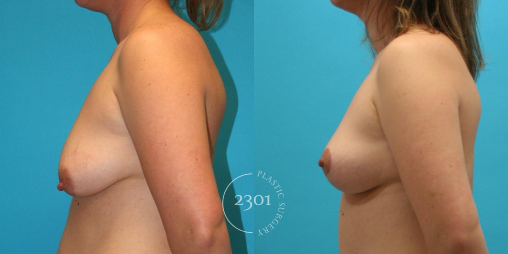 Before & After Breast Lift (Mastopexy) Case 26 View #2 View in Fort Worth, Plano, & Frisco, Texas