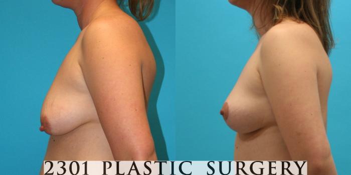 Before & After Breast Lift (Mastopexy) Case 26 View #2 View in Fort Worth, Plano, & Frisco, Texas