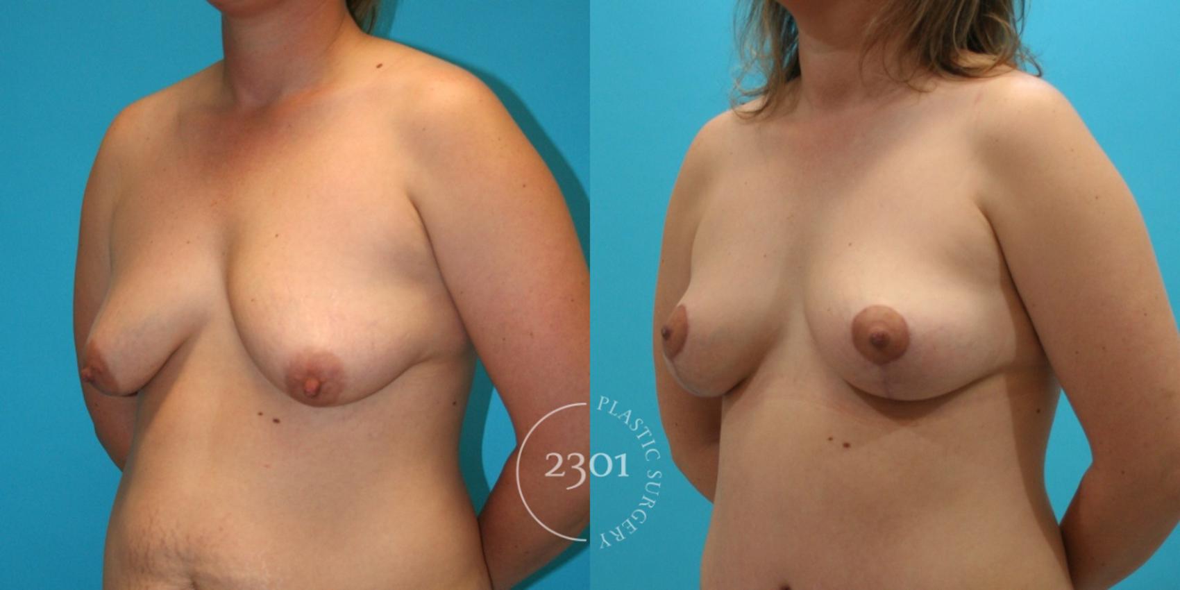 Before & After Breast Lift (Mastopexy) Case 26 View #3 View in Fort Worth, Plano, & Frisco, Texas