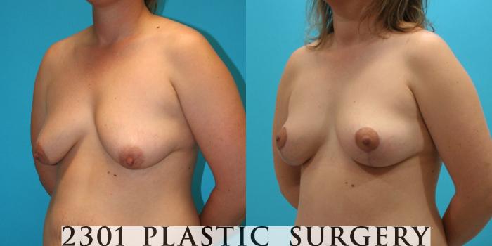 Before & After Breast Lift (Mastopexy) Case 26 View #3 View in Fort Worth, Plano, & Frisco, Texas