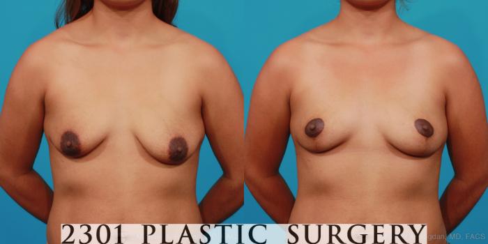 Before & After Breast Lift (Mastopexy) Case 292 View #1 View in Fort Worth, Plano, & Frisco, Texas
