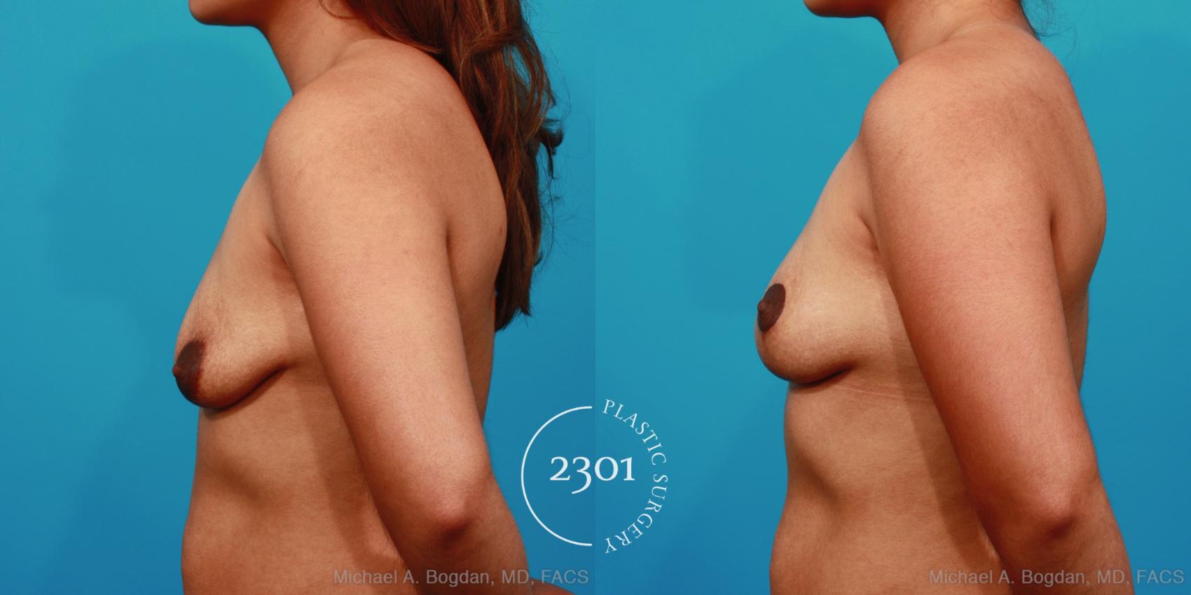 Before & After Breast Lift (Mastopexy) Case 292 View #2 View in Fort Worth, Plano, & Frisco, Texas