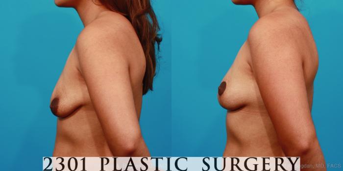 Before & After Breast Lift (Mastopexy) Case 292 View #2 View in Fort Worth, Plano, & Frisco, Texas