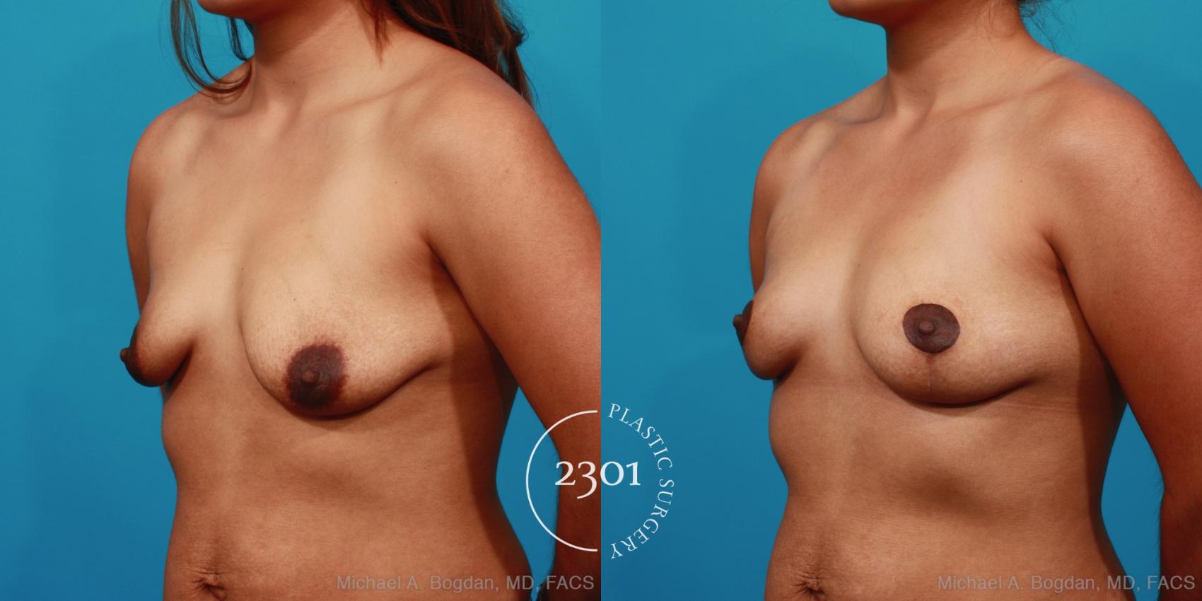 Before & After Breast Lift (Mastopexy) Case 292 View #3 View in Fort Worth, Plano, & Frisco, Texas