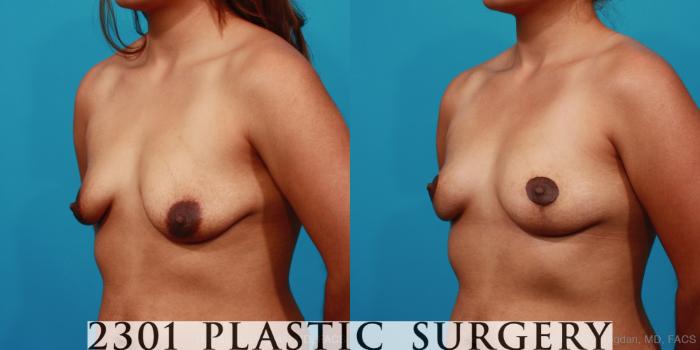Before & After Breast Lift (Mastopexy) Case 292 View #3 View in Fort Worth, Plano, & Frisco, Texas