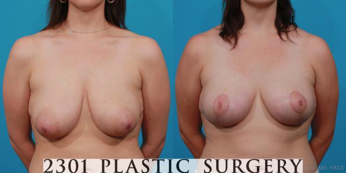 Before & After Breast Lift (Mastopexy) Case 297 View #1 View in Fort Worth, Plano, & Frisco, Texas