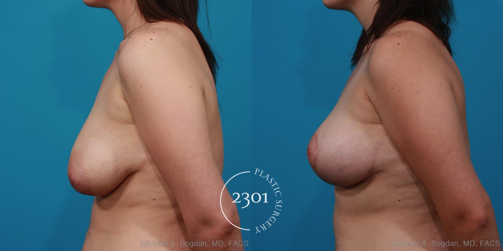 Before & After Breast Lift (Mastopexy) Case 297 View #2 View in Fort Worth, Plano, & Frisco, Texas