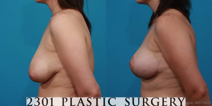 Before & After Breast Lift (Mastopexy) Case 297 View #2 View in Fort Worth, Plano, & Frisco, Texas