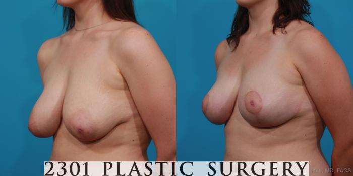 Before & After Breast Lift (Mastopexy) Case 297 View #3 View in Fort Worth, Plano, & Frisco, Texas