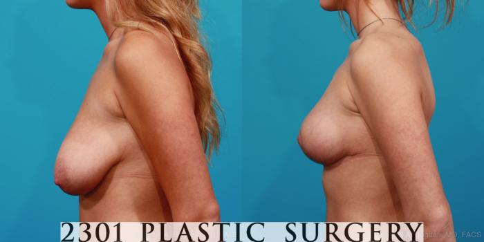 Before & After Breast Lift (Mastopexy) Case 320 View #2 View in Fort Worth, Plano, & Frisco, Texas