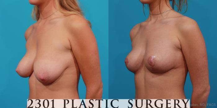 Before & After Breast Lift (Mastopexy) Case 320 View #3 View in Fort Worth, Plano, & Frisco, Texas