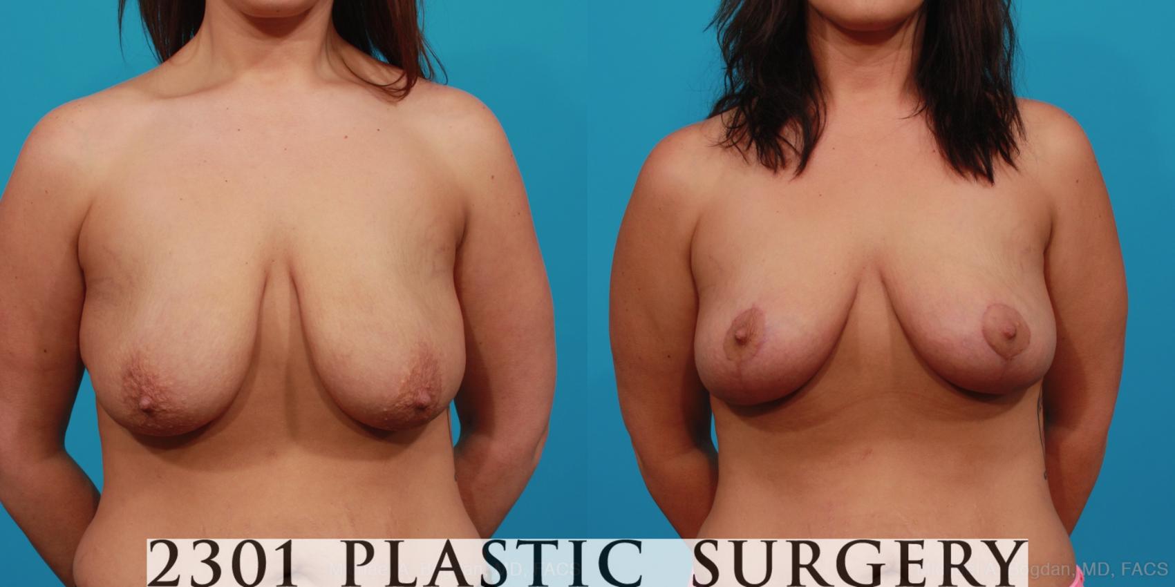 Before & After Breast Lift (Mastopexy) Case 346 View #1 View in Fort Worth, Plano, & Frisco, Texas