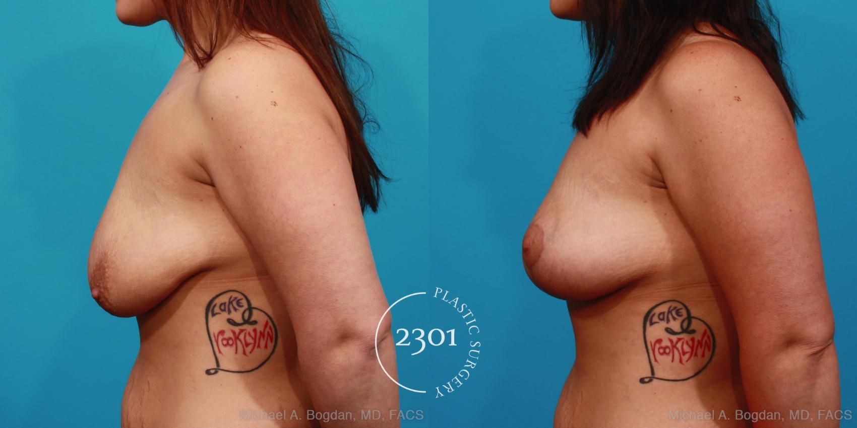 Before & After Breast Lift (Mastopexy) Case 346 View #2 View in Fort Worth, Plano, & Frisco, Texas