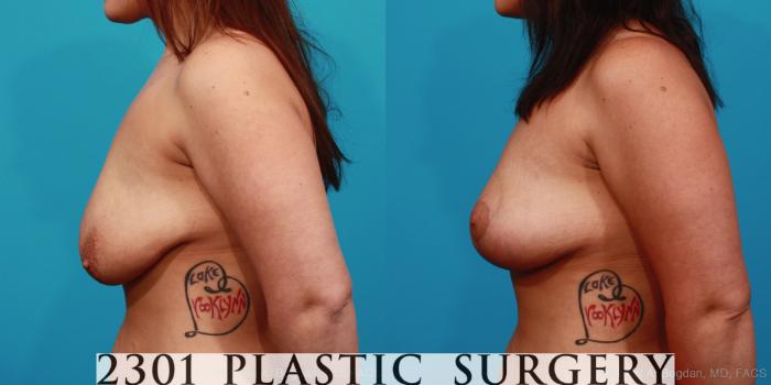 Before & After Breast Lift (Mastopexy) Case 346 View #2 View in Fort Worth, Plano, & Frisco, Texas