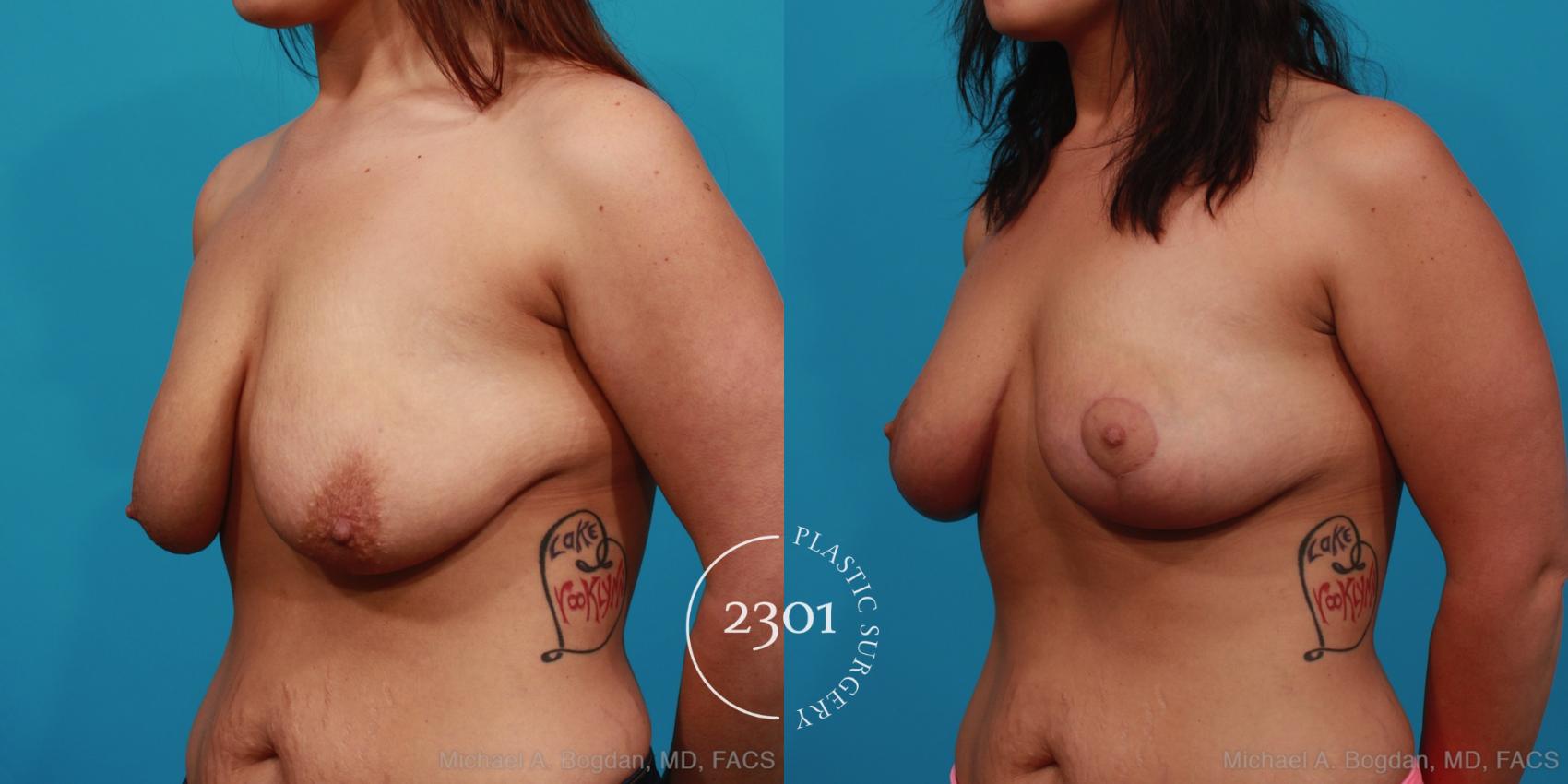 Before & After Breast Lift (Mastopexy) Case 346 View #3 View in Fort Worth, Plano, & Frisco, Texas