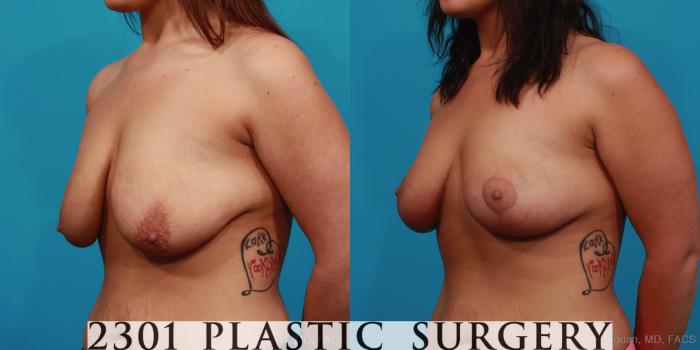 Before & After Breast Lift (Mastopexy) Case 346 View #3 View in Fort Worth, Plano, & Frisco, Texas
