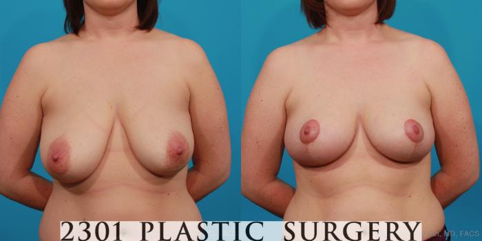 Before & After Breast Lift (Mastopexy) Case 350 View #1 View in Fort Worth, Plano, & Frisco, Texas