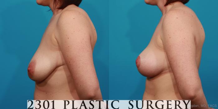 Before & After Breast Lift (Mastopexy) Case 350 View #2 View in Fort Worth, Plano, & Frisco, Texas