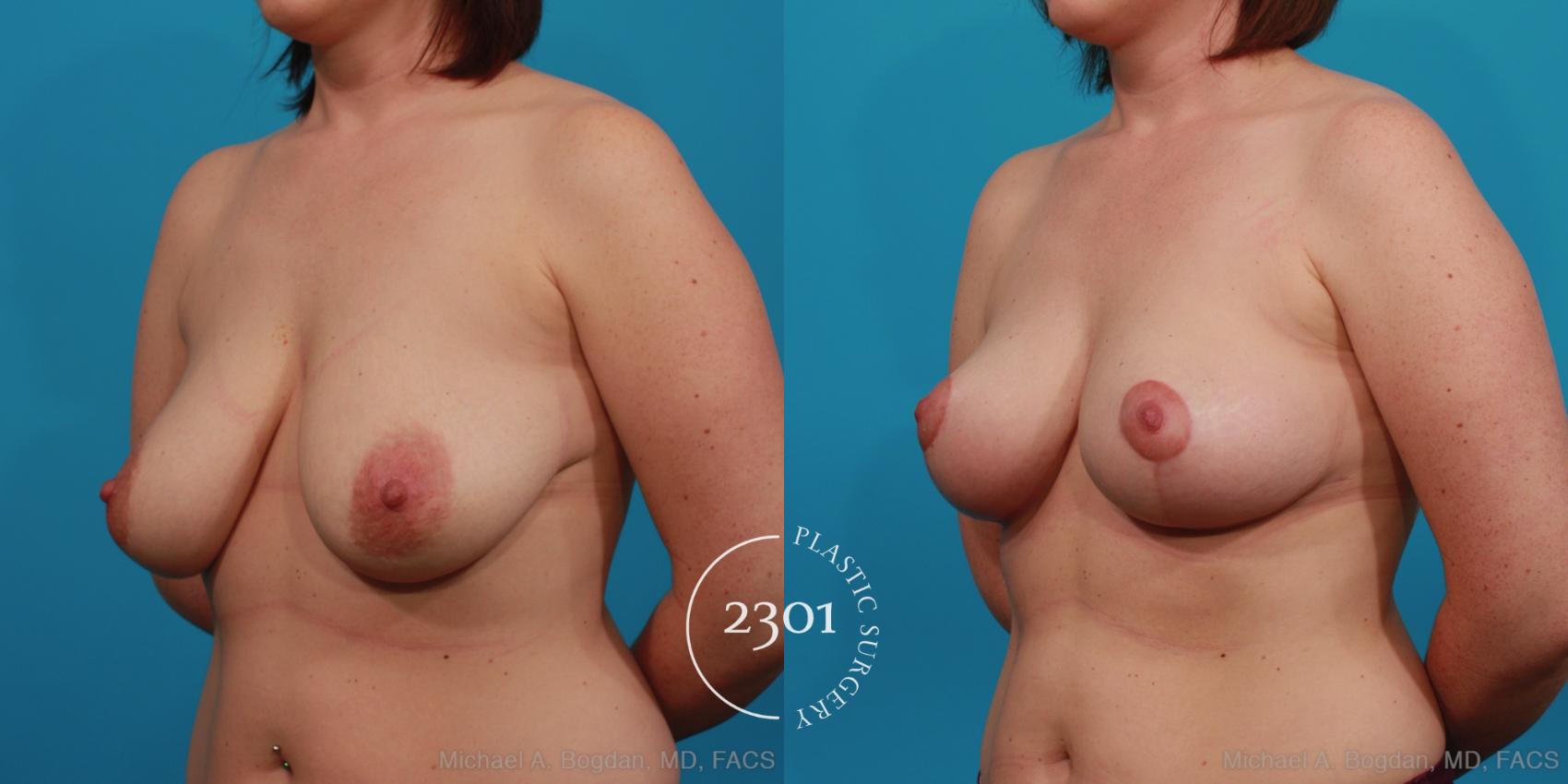 Before & After Breast Lift (Mastopexy) Case 350 View #3 View in Fort Worth, Plano, & Frisco, Texas