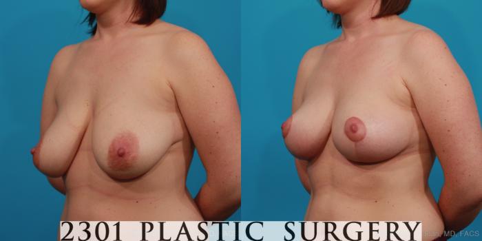 Before & After Breast Lift (Mastopexy) Case 350 View #3 View in Fort Worth, Plano, & Frisco, Texas